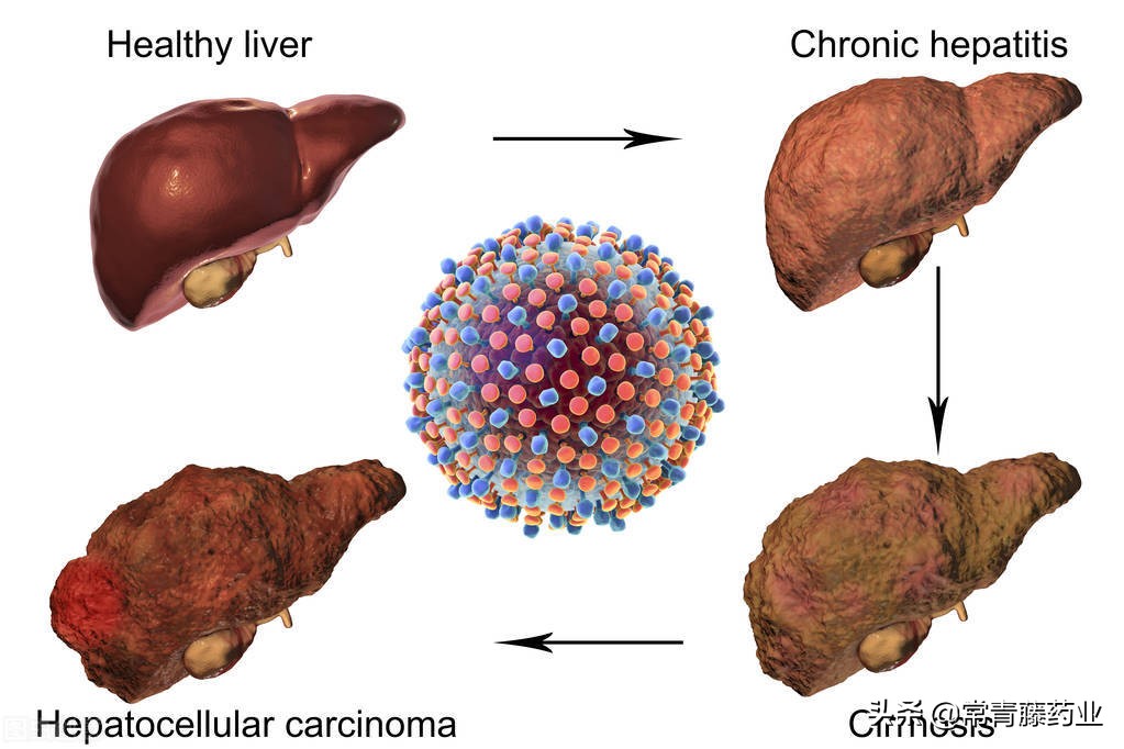 研发创新药实现肝健康(图1)